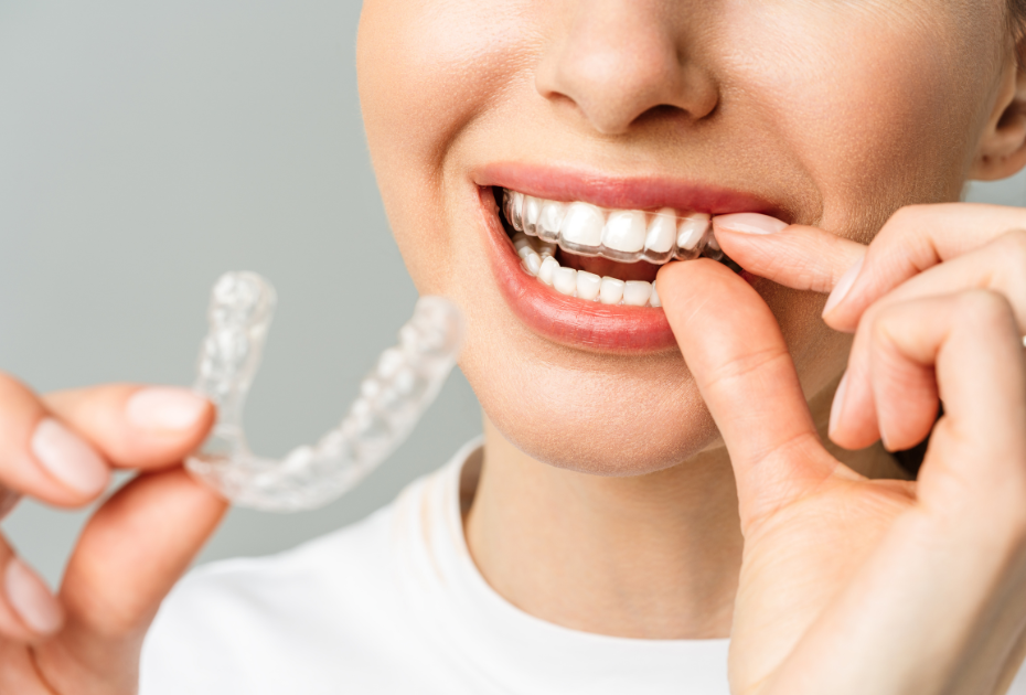 How Clear Aligners Address Common Dental Issues: Overbites, Underbites, and More