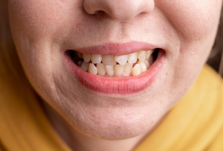 Preventing Dental Crowding: Tips for Parents