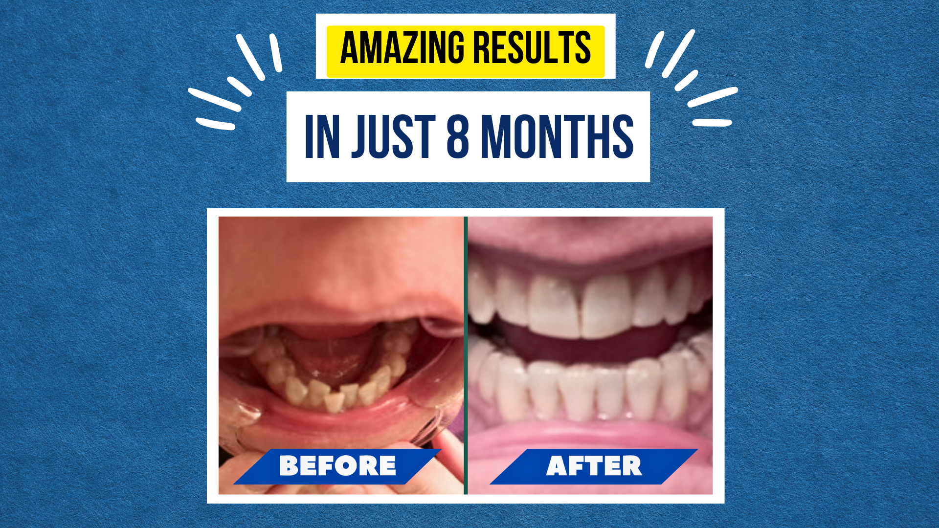 Melissa’s Smile Story - A Journey to Confidence with Smileie Clear Aligners