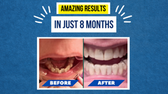 Melissa’s Smile Story - A Journey to Confidence with Smileie Clear Aligners