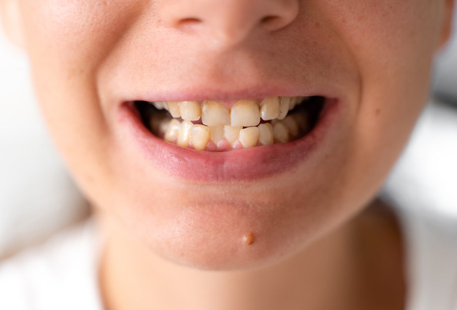 Close-up of teeth with an overbite before clear aligner treatment.