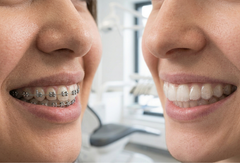 Clear Aligners vs. Braces: What’s Best for Essex County Adults?