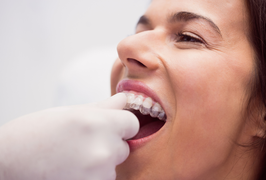 Woman wearing clear aligners showing how invisible braces work