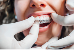 Do Clear Aligners Work for Gaps, Crooked Teeth and Overbites? Expert Answers