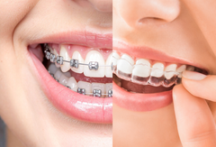 Clear Aligners vs Braces: Why Modern Patients Prefer Removable Options