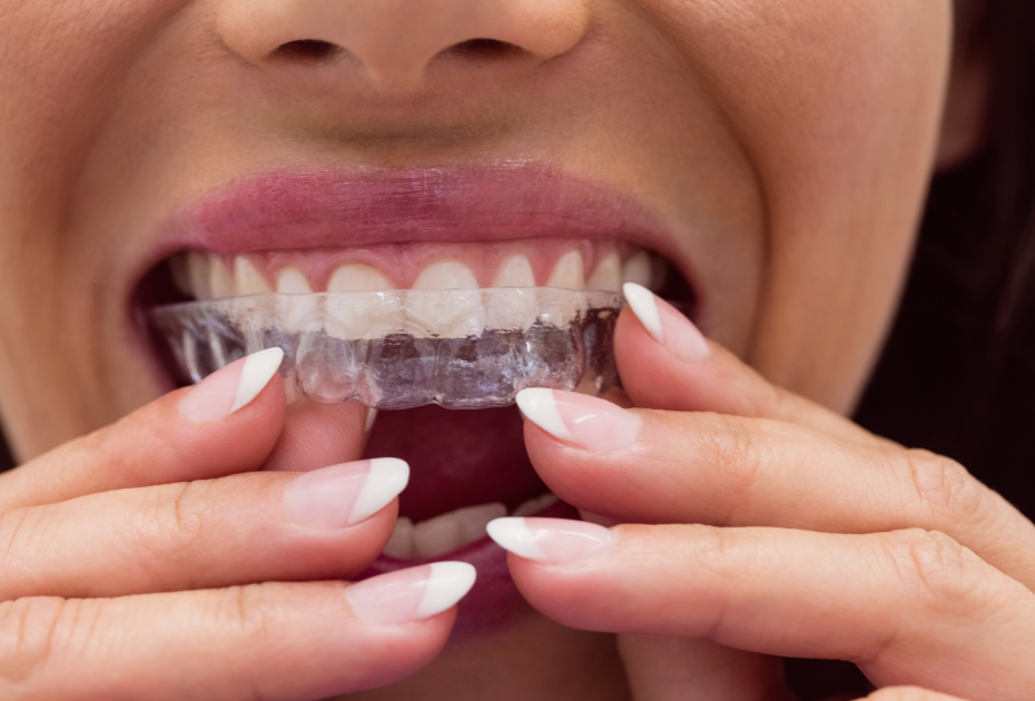 Woman wearing clear aligners on her teeth, gently fitting them onto her gums for a straighter, pain-free smile Smileie invisible aligners comfort and care.