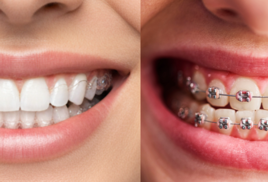 Close-up comparison of clear aligners vs metal braces on two smiling mouths, showing difference between invisible aligners and traditional braces
