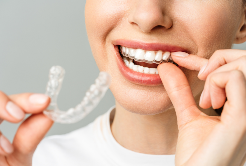 Person placing clear aligners on teeth, holding an invisible braces tray for at-home teeth straightening