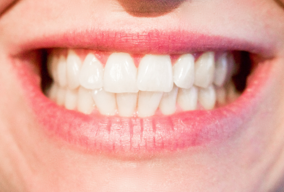 Clear aligners result showing straight, aligned teeth after treatment for mild to moderate crowding