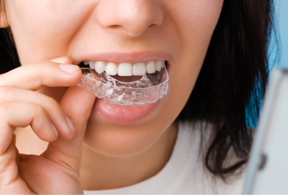 Woman wearing a clear aligner on lower teeth, showing partial clear aligner treatment for one jaw