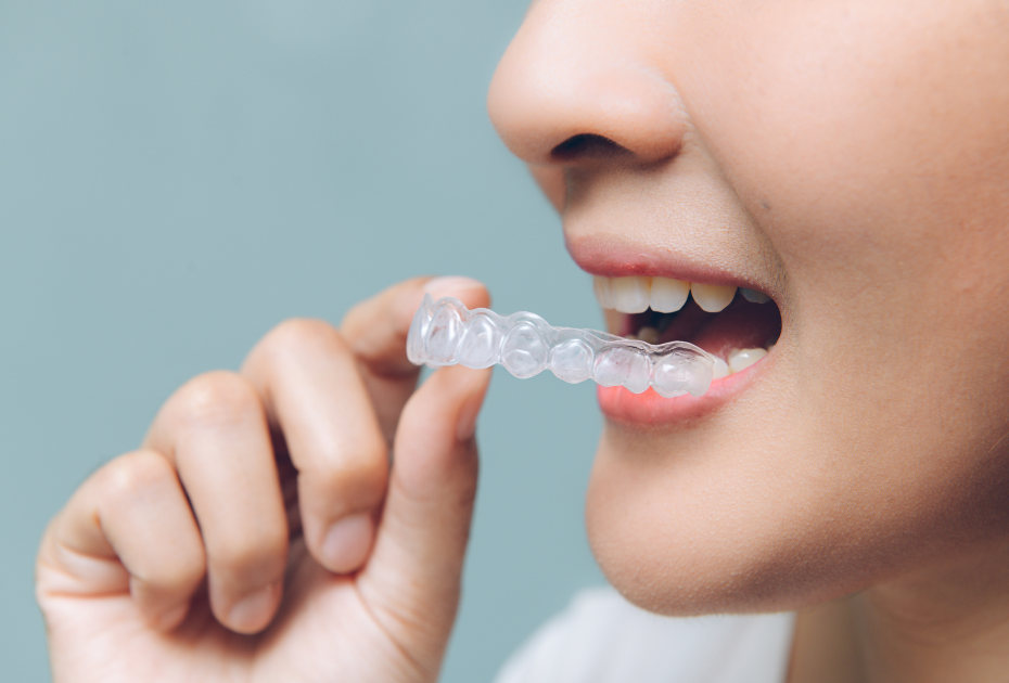 Person inserting clear aligners during the first week of aligner treatment