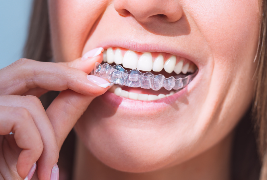 Woman placing transparent invisible braces on her teeth, showing clear aligners for teeth straightening.