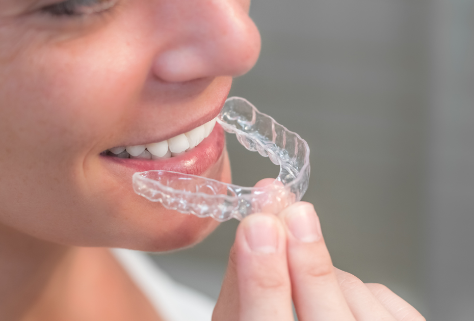 Person holding clear aligners close to her teeth, demonstrating how aligners fit over teeth for orthodontic treatment.