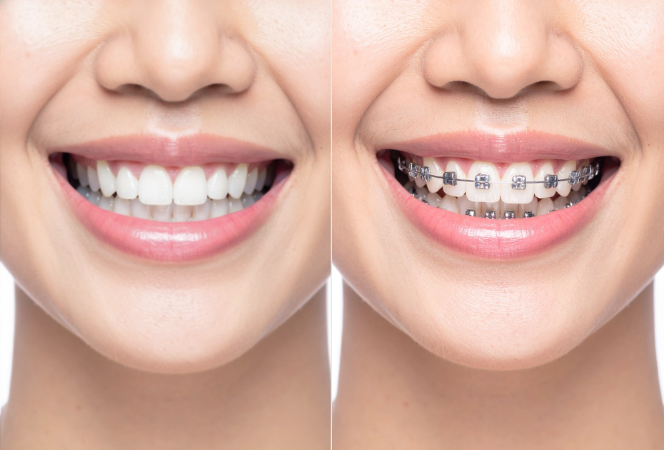Side-by-side comparison of a smiling mouth with clear aligners and traditional metal braces, showing the visual difference between orthodontic treatment options.