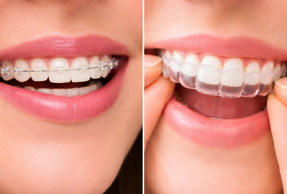 Clear Aligners vs Ceramic Braces: Best Option for Professionals