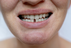 Clear Aligners for Gaps: How Treatment Typically Works