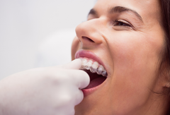 Clear Aligners for Social Confidence: Everyday Benefits You’ll Notice