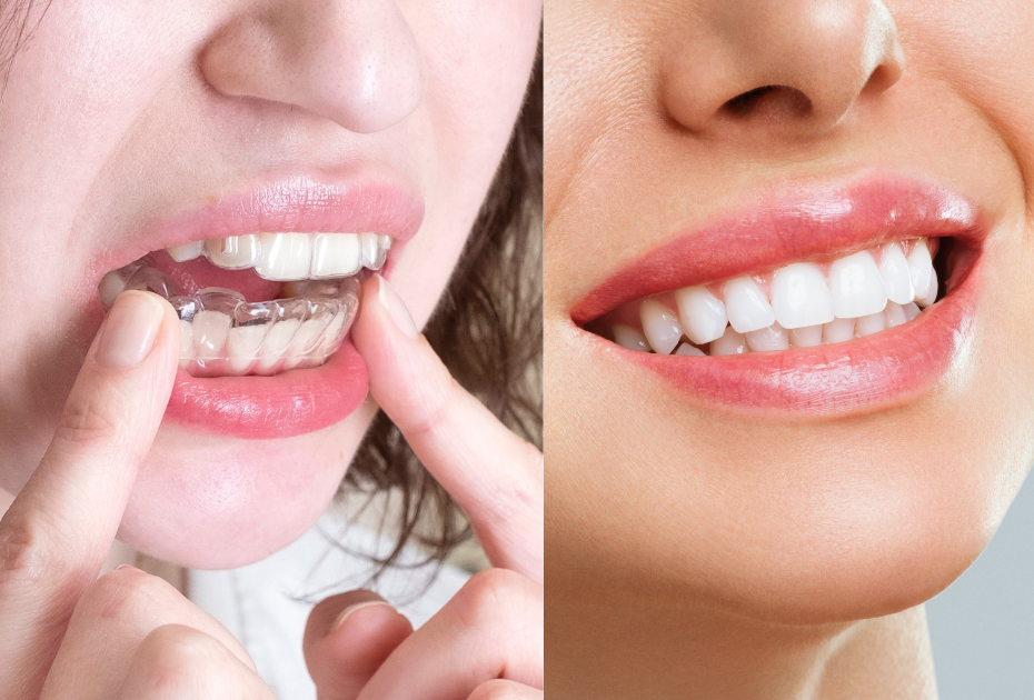 Side-by-side view of clear aligners being placed and a bright, straight white smile showing results after treatment.