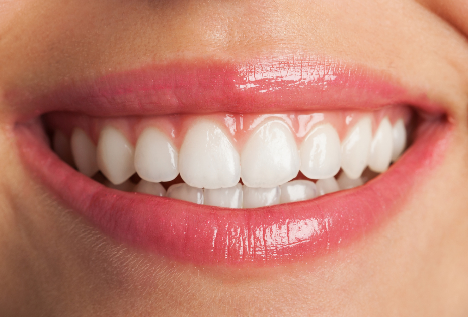 Close-up of a bright, straight smile showing aligned white teeth, reflecting confidence and improved self-esteem.