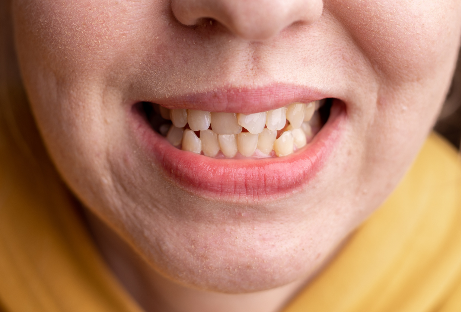 Slightly overlapping front teeth showing mild crowding, suitable for clear aligner treatment.