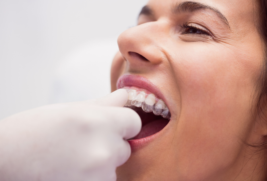 Clear dental aligner being fitted on a patient’s teeth during orthodontic treatment for minor corrections.