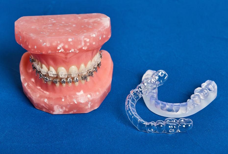 Clear aligners vs traditional orthodontics with braces on dental model illustrating modern orthodontics USA options.