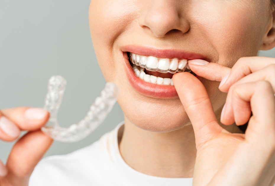 clear aligners lifestyle USA woman inserting invisible braces at home.