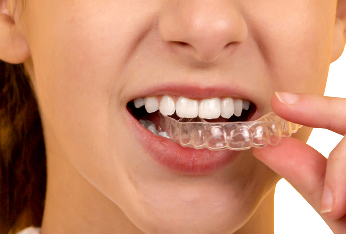 Maintaining Your Smile Post-Treatment: The Importance of Retainers