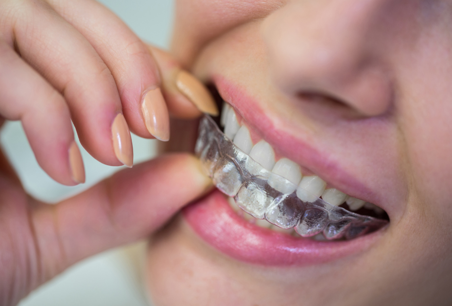 Woman placing clear retainer on teeth after aligner treatment