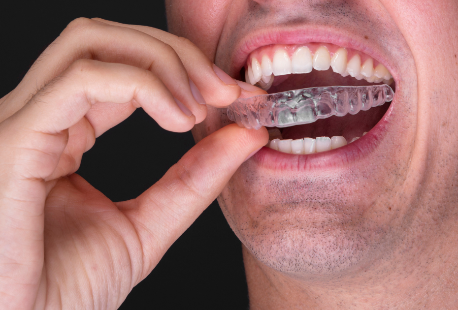 Man putting in a clear aligner to maintain the recommended 22-hour daily wear time.